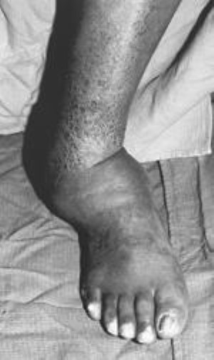 charcot arthropathy