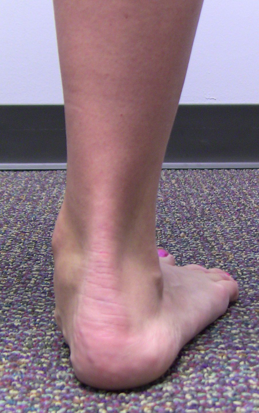 Shin Splints Orthoinfo Aaos