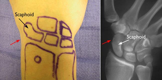 Location of the scaphoid in wrist