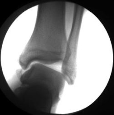 Ankle instabillity