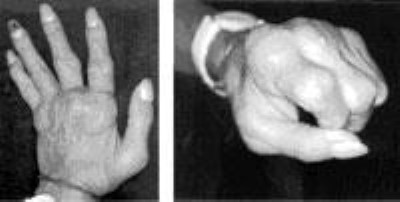 Photo of rheumatoid arthritis of the hand