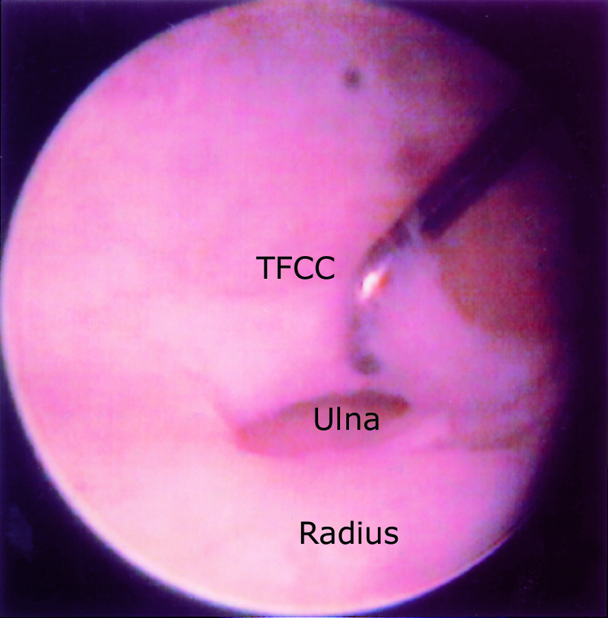 Wrist Arthroscopy - OrthoInfo - AAOS