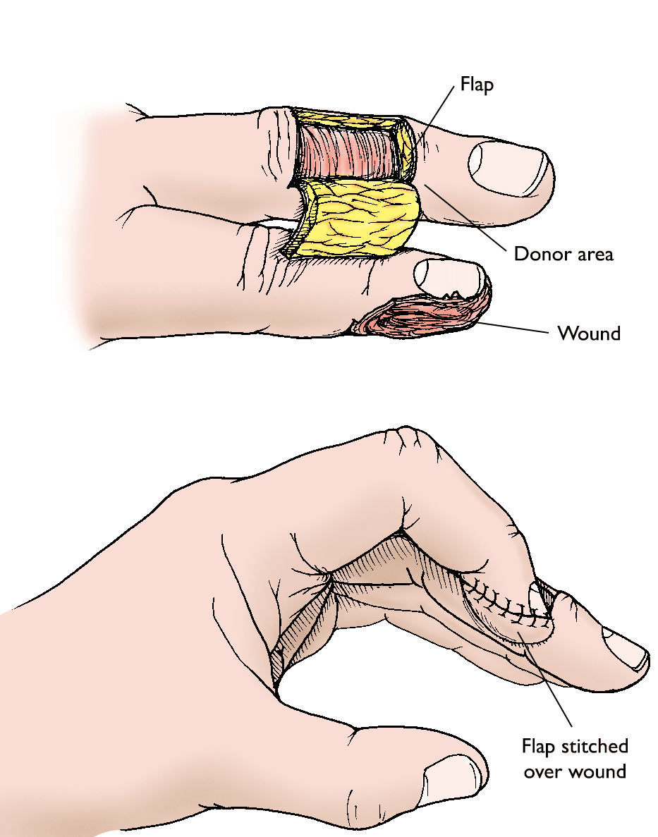 Fingertip Injuries and Amputations - OrthoInfo - AAOS