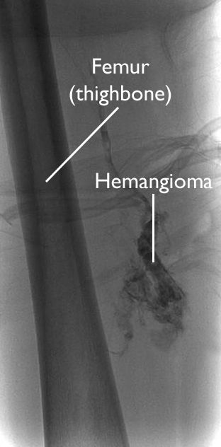 angiograma de hemangioma en muslo