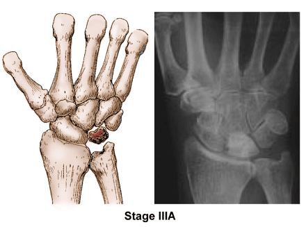 Kienböck's disease stage 3