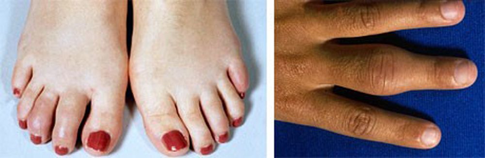Inchaço dos dedos das mãos e dos pés da artrite juvenil