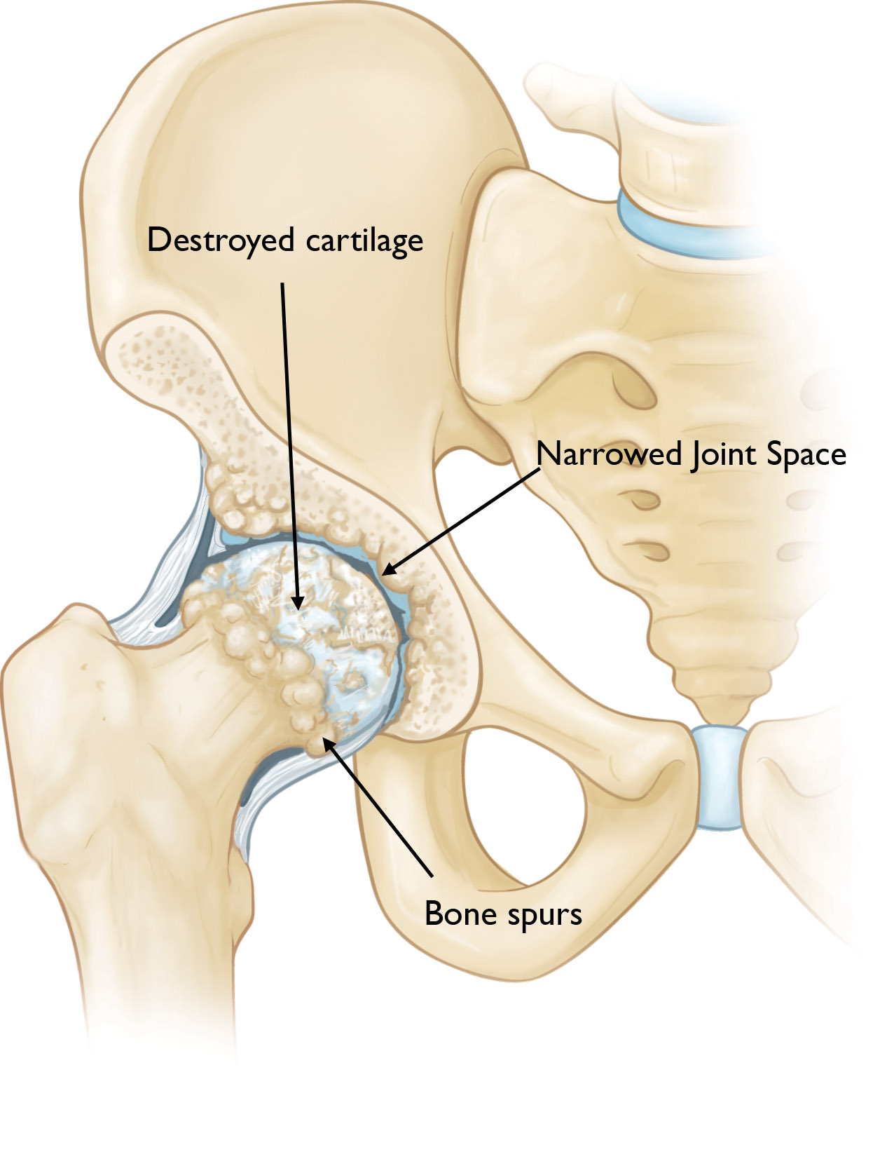 Hip osteoarthritis