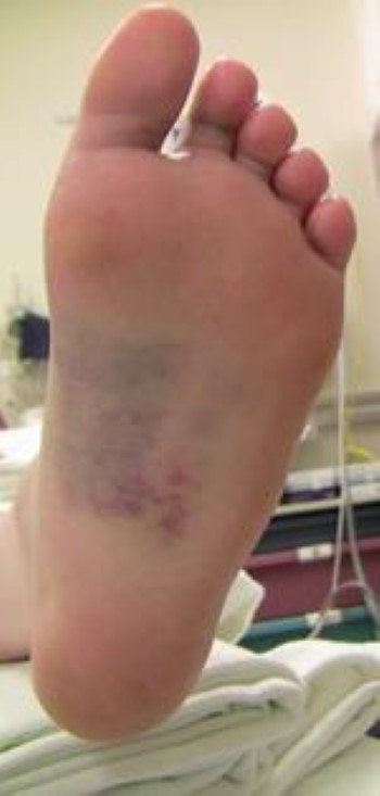 Bruised bottom store of foot