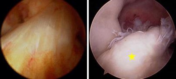 arthroscopic images of normal ACL and ACL tear