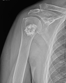 X-ray of Enchondroma