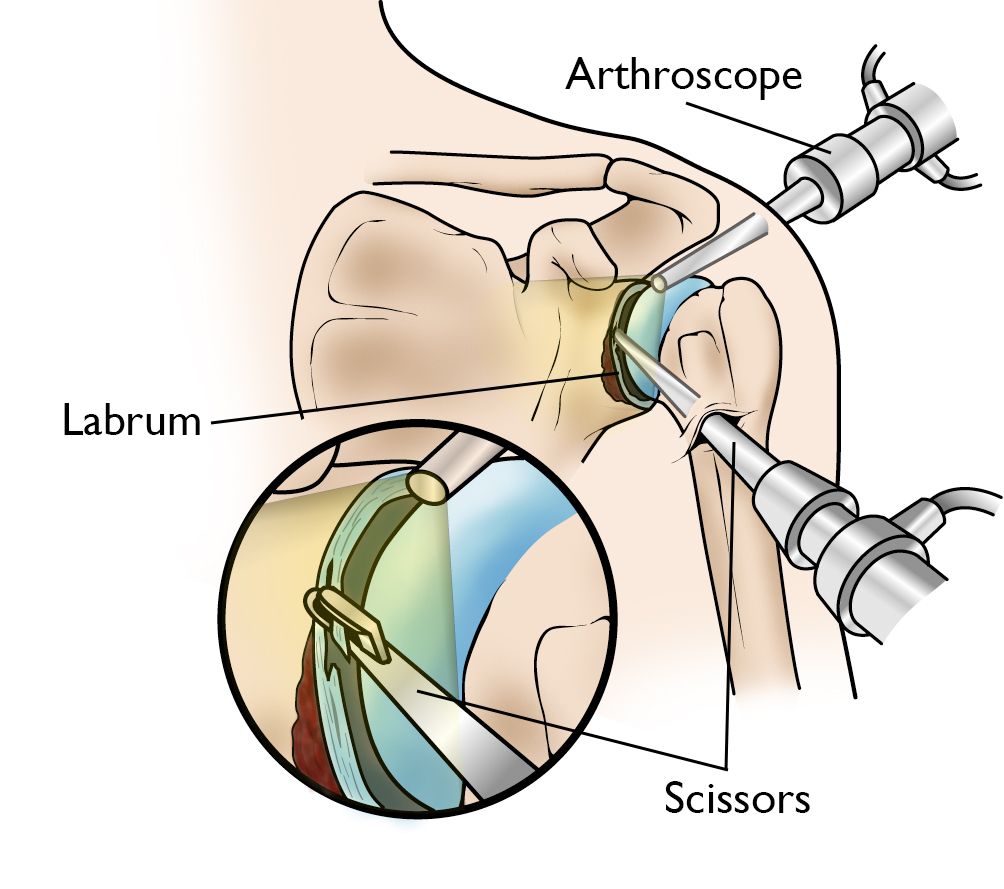 artroscopia de hombro