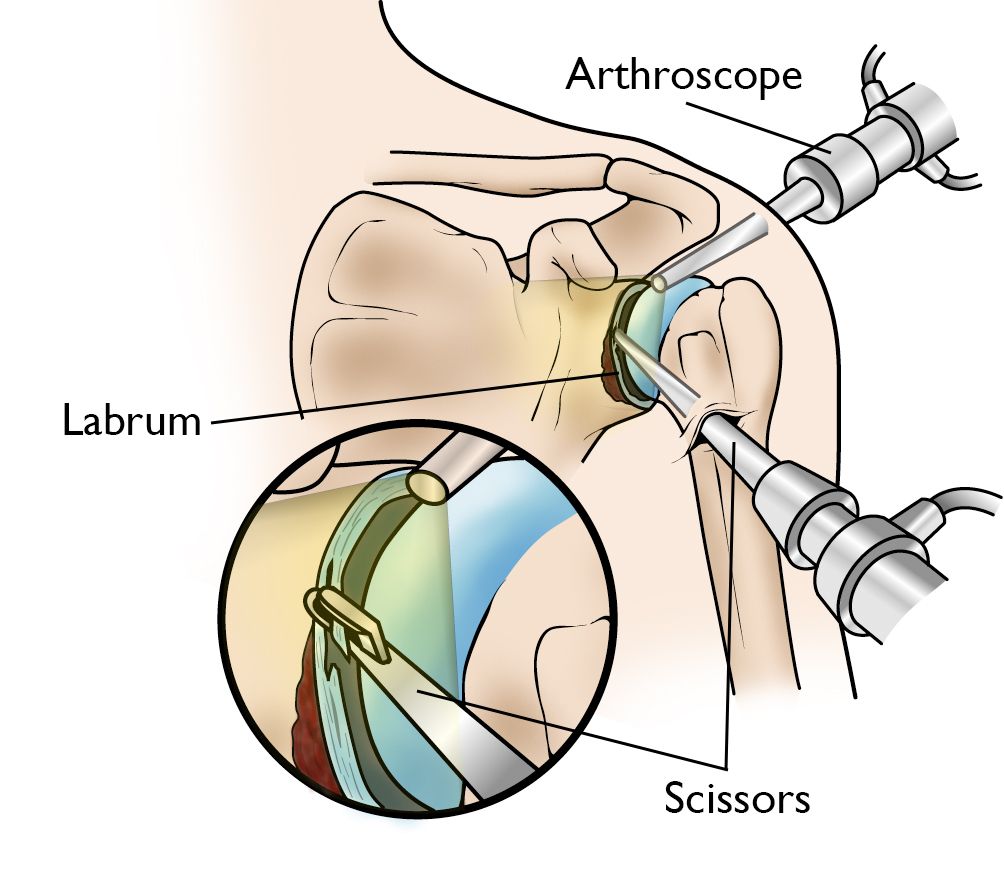 slap tear surgery failure