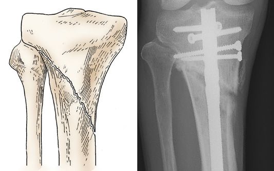 Internal fixation of proximal tibia fracture