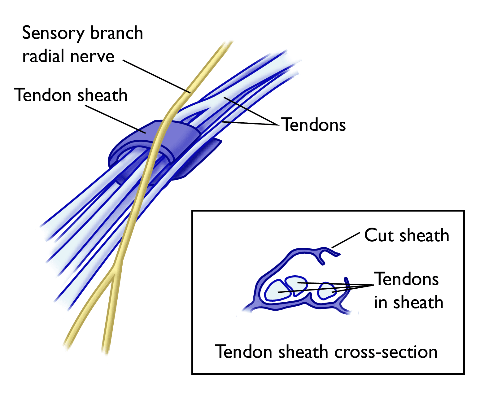 Tenosinovitis de Quervain (Tendinitis extensor del pulgar) – MEDS