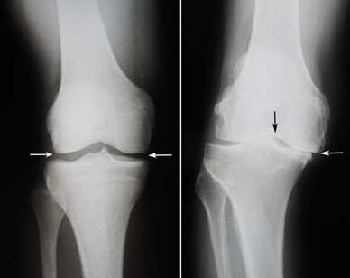 Es necesario operar la rodilla con artritis?