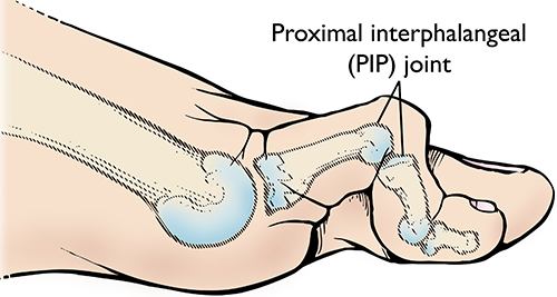 PIP joint