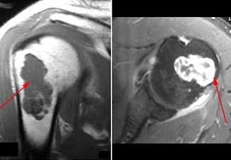 Resonancias magnéticas de encondroma en la parte superior del brazo