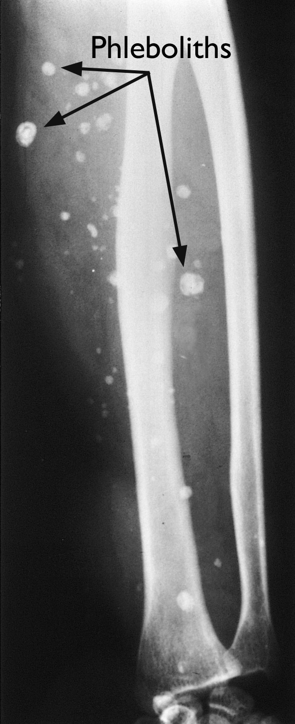 x-ray image of phleboliths