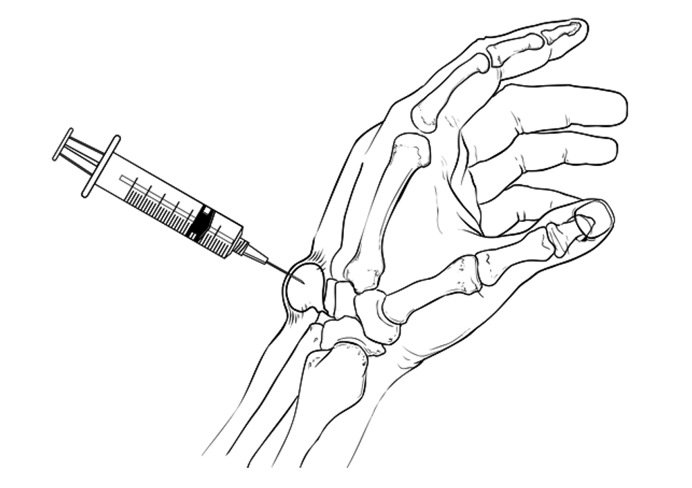 Ganglion Cyst of the Wrist and Hand - Mendelson Kornblum