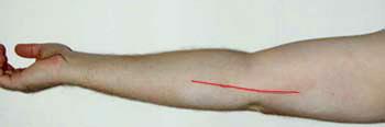 Location of incision for anterior transposition of ulnar nerve