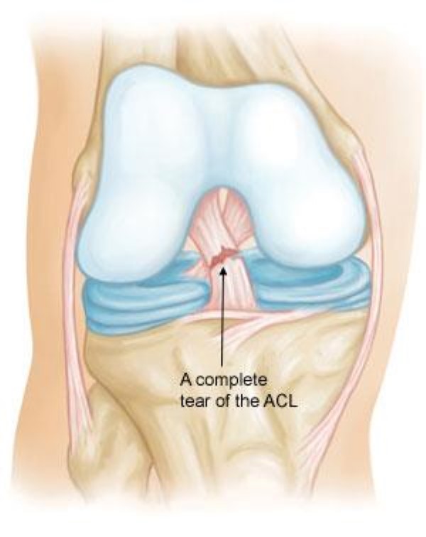 Image result for cruciate ligament tear