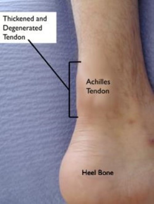 Calcaneal tendon pain on sale treatment