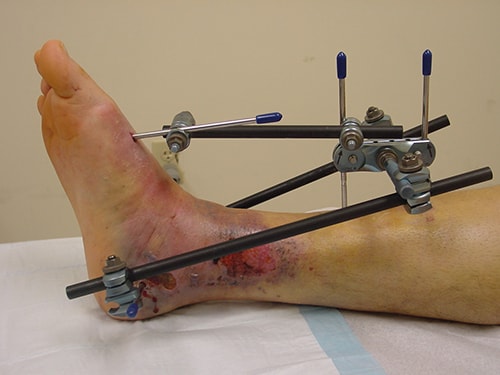 Pilon Fracture of the Ankle