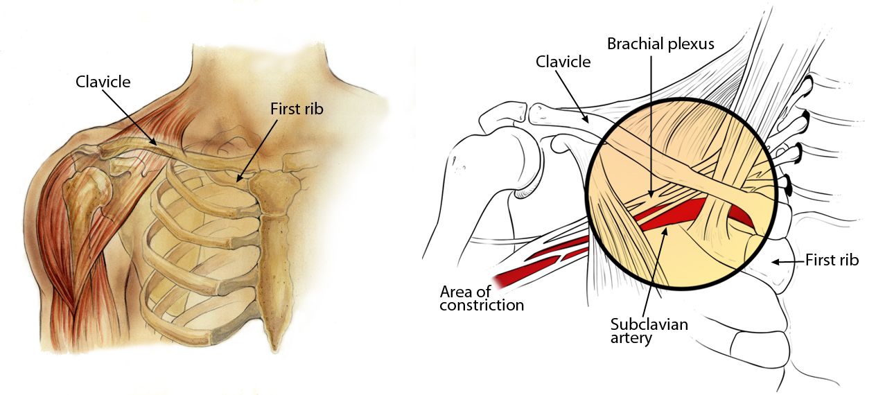 injury blog: thoracic outlet syndrome