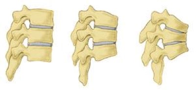Illustrations of normal vertebrae and vertebrae with osteoporosis
