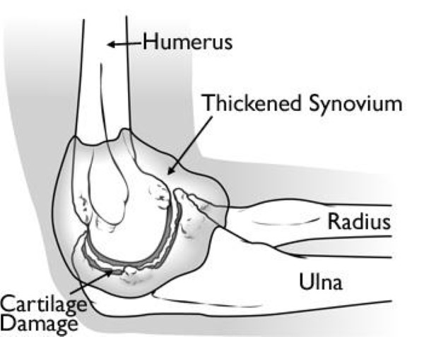 Arthrotomy Elbow