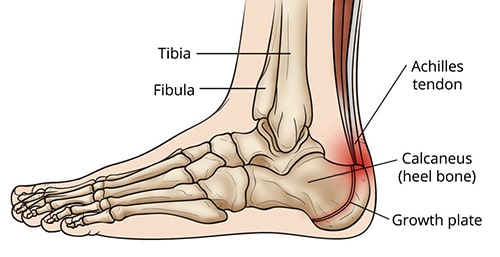 area of pain from Sever's disease