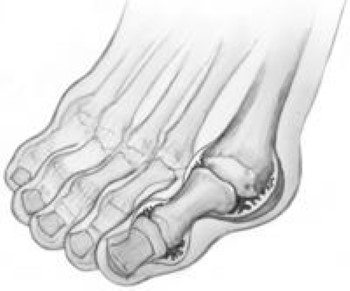 arthritis in little toe