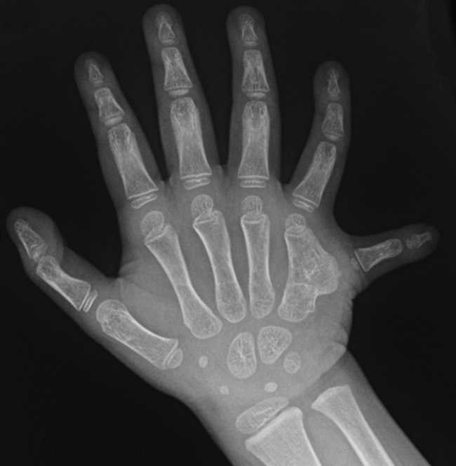 polydactyly