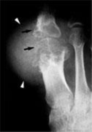 x-ray of advanced gout in big toe