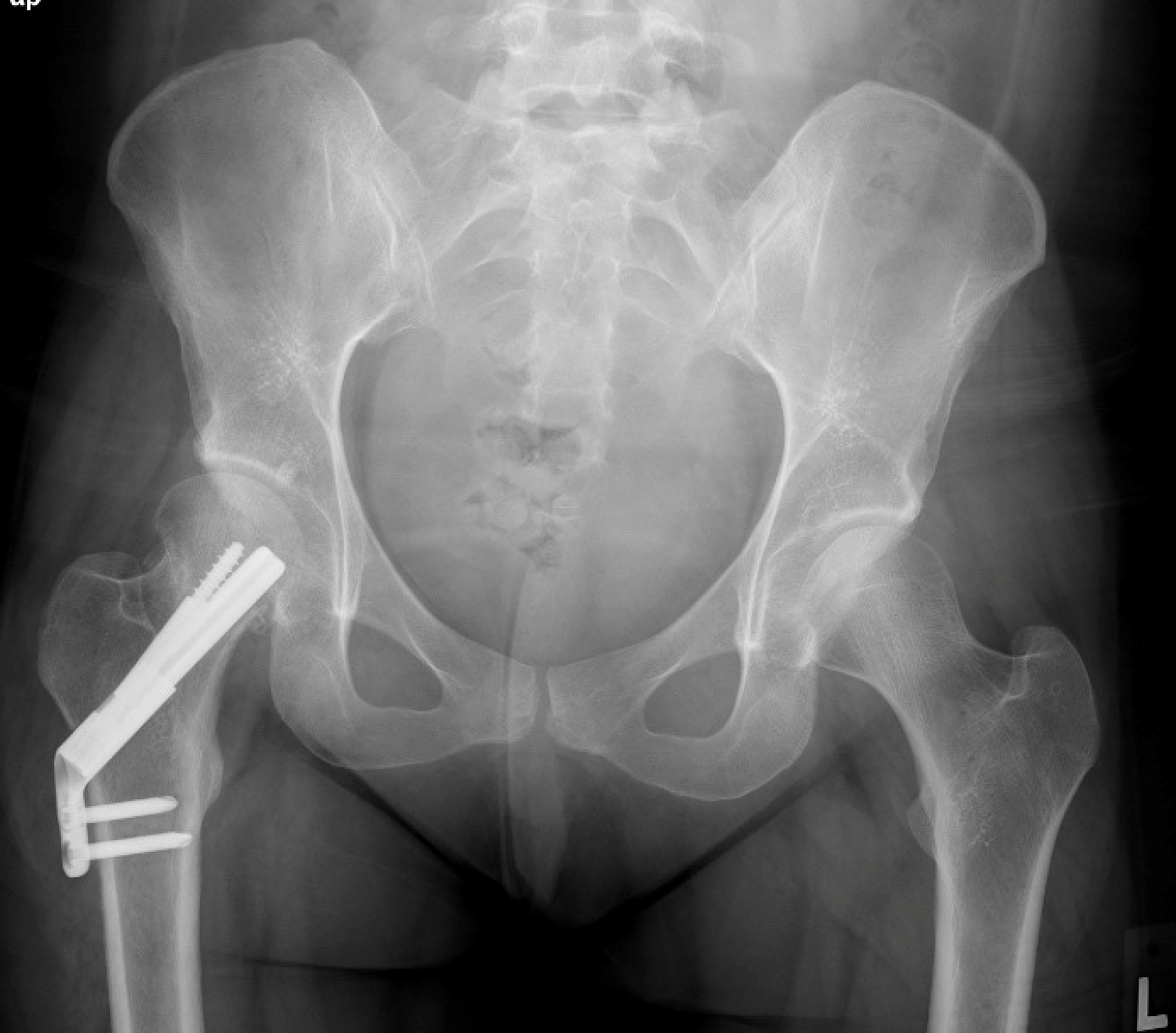Fixation of Hip Fracture With Plate and Screw Device