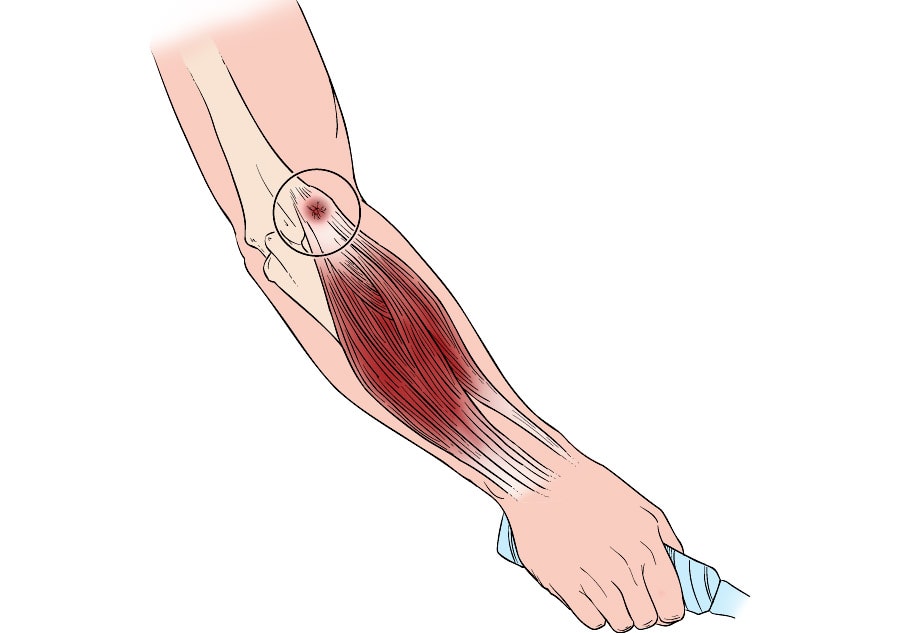 Lateral Epicondylitis Test