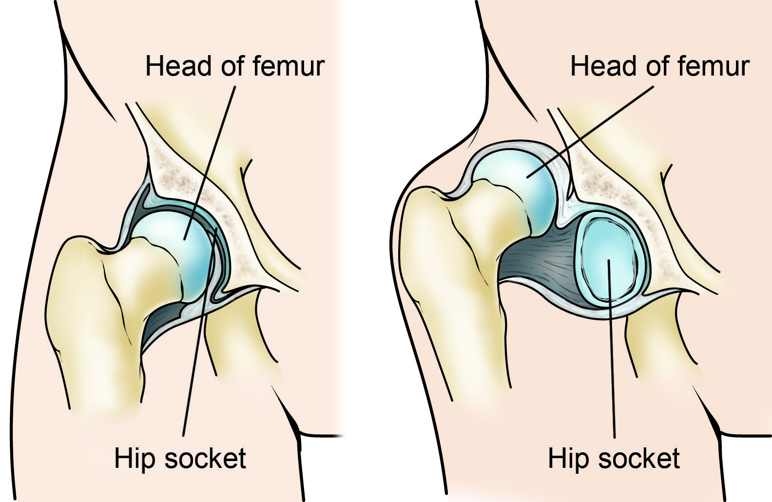 Illustrations of a normal hip and a dislocated hip