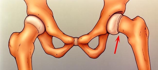 Slipped capital femoral epiphysis (SCFE)