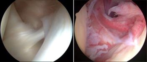 arthroscopic image of frozen shoulder