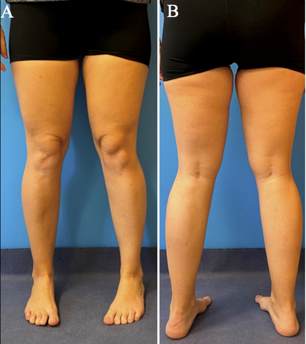 Tibial torsion