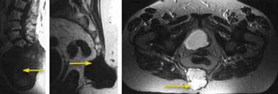 MRI scans showing chordomas