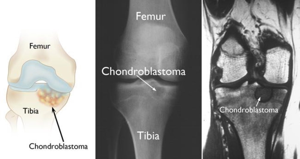 La ilustración (izquierda), la radiografía (centro) y la resonancia magnética (derecha) muestran un condroblastoma en la parte superior de la tibia (tibia).  Esta es una ubicación común para que se produzcan los tumores.
