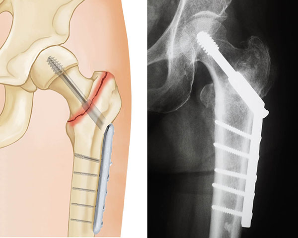 hip fracture treated with compression screw and side plate