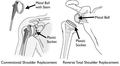 Illustrations of total shoulder replacement and reverse total shoulder replacement
