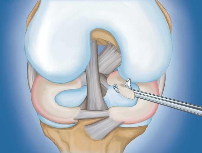 Primer plano de meniscectomía parcial