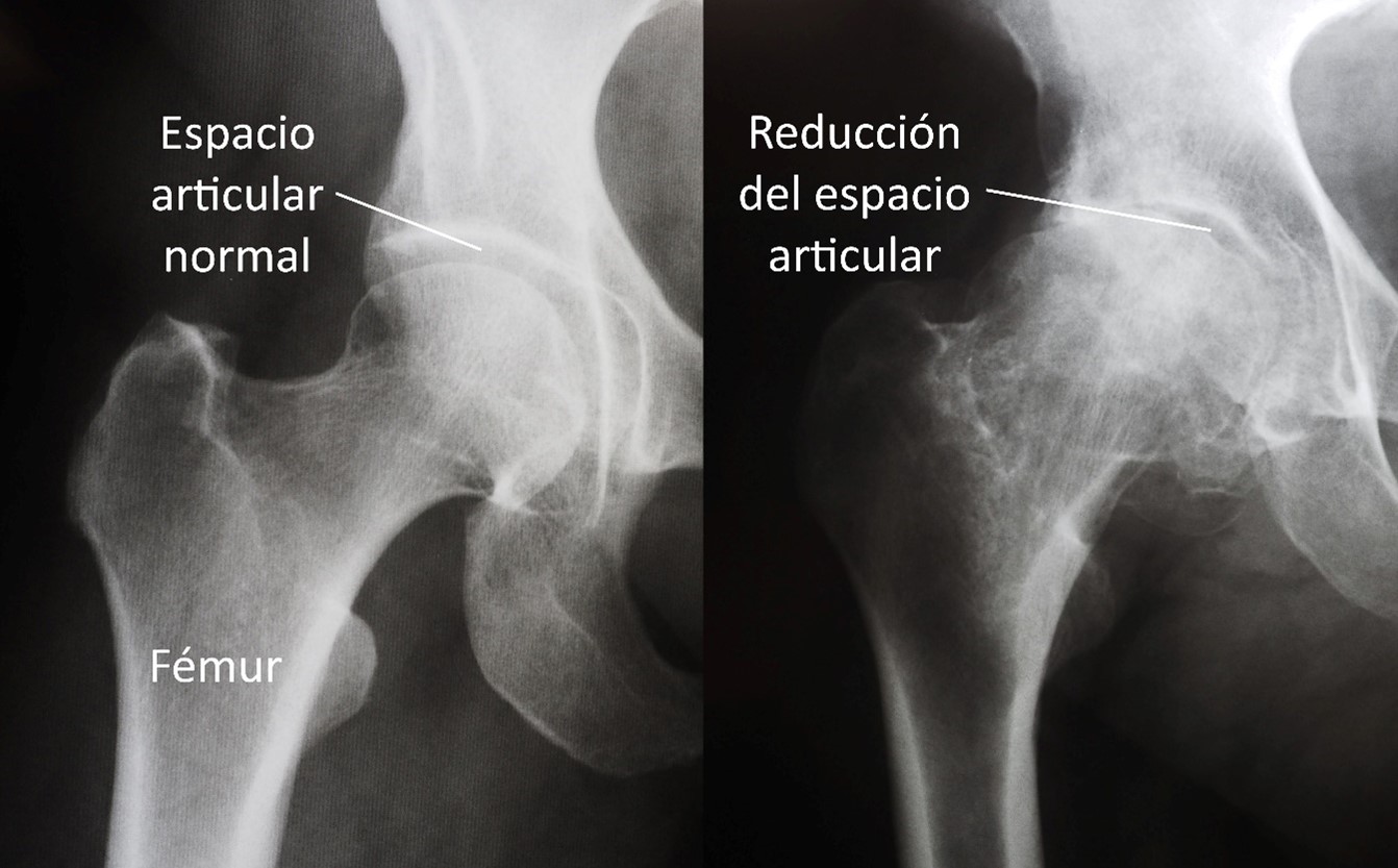 Reemplazo Total De Cadera Total Hip Replacement Orthoinfo Aaos 2168