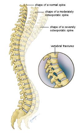 osteoporosis fracture recovery