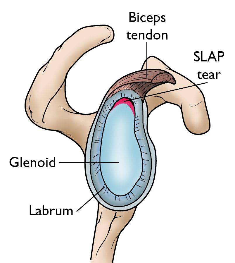 shoulder tear treatment