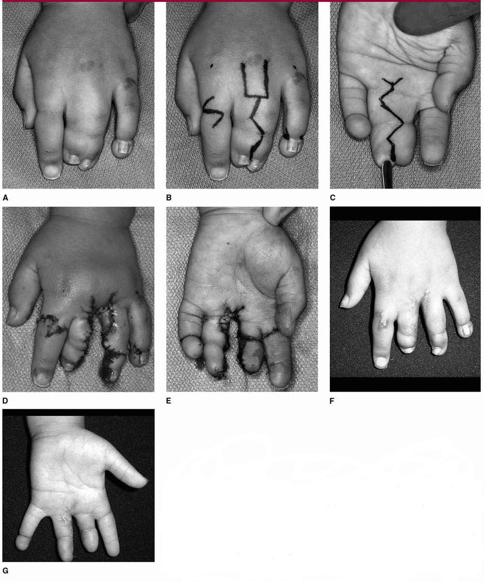 Syndactyly and Amniotic Band Syndrome