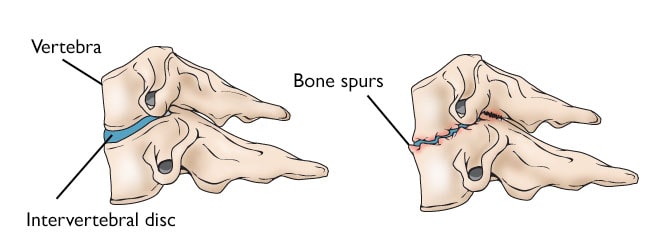 illustrations of healthy and degenerated cervical disks